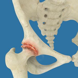 Understanding Total Hip Replacement: When is it the Right Choice?