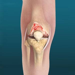 Understanding Total Knee Replacement: When is it the Right Choice?