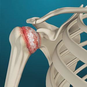 Understanding Total Shoulder Replacement: When is it the Right Choice?